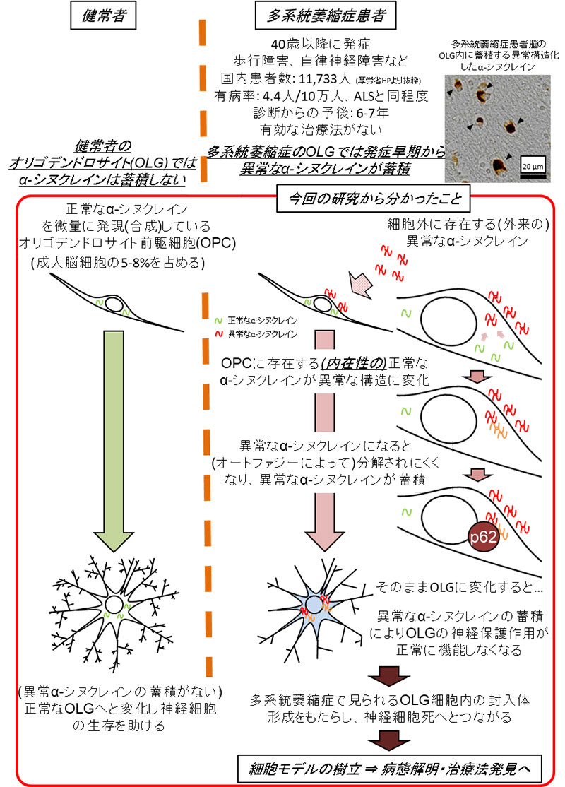 多系統萎縮症