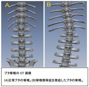 マルファン症候群