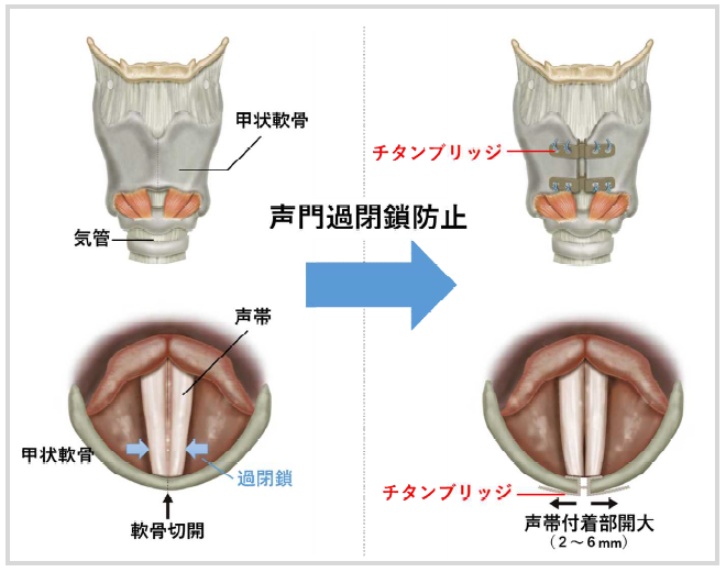 けいれん性発声障害