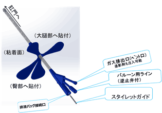 直腸がん
