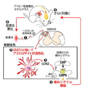 アトピー