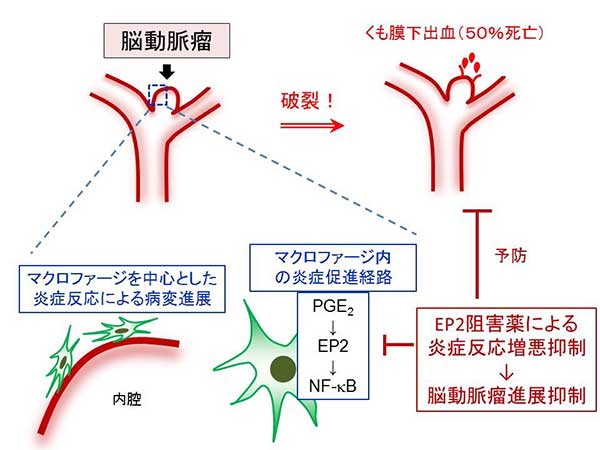 脳動脈瘤