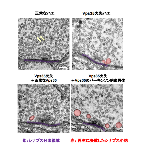 パーキンソン病