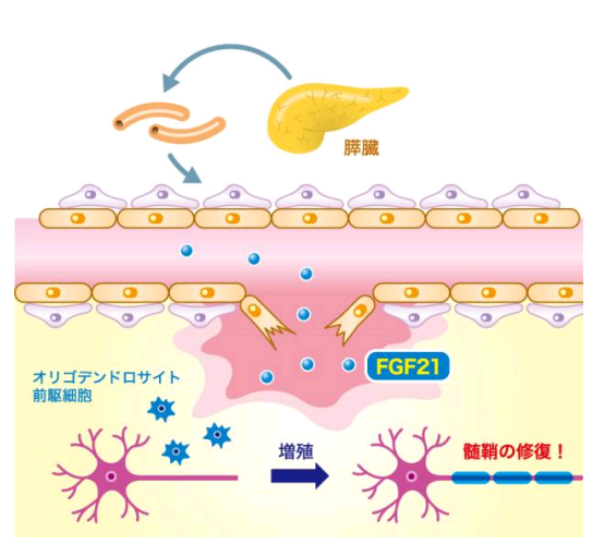 多発性硬化症