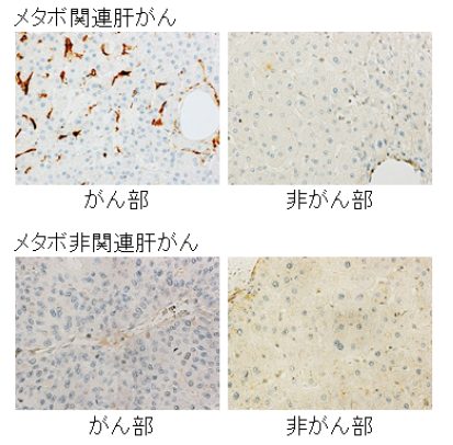 メタボ関連肝がんバイオマーカー