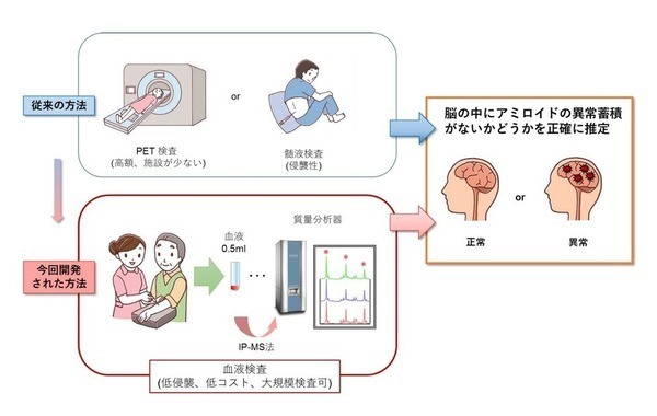 アルツハイマー病変