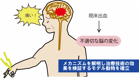 脳卒中後疼痛
