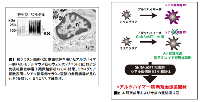 アルツハイマー病